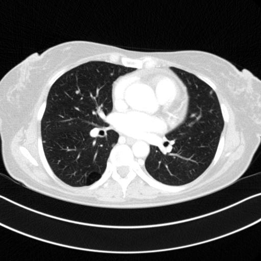 Original VENOUS CT scan