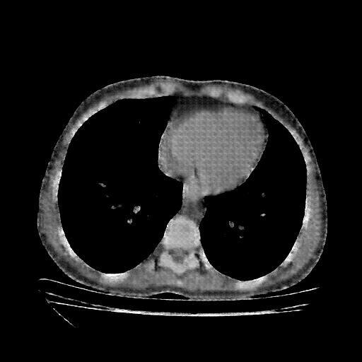 Reconstructed NATIVE CT scan (cycle consistency)