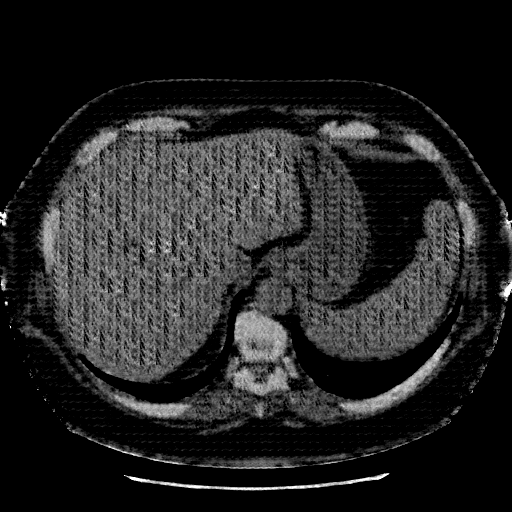 Generated VENOUS CT scan (A→B translation)