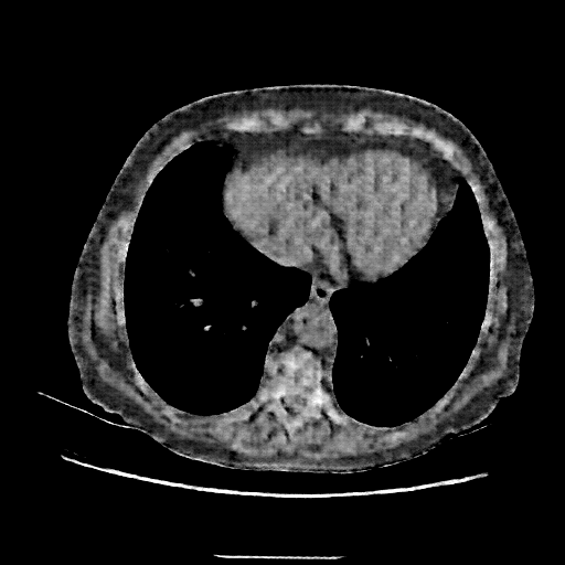 Reconstructed NATIVE CT scan (cycle consistency)