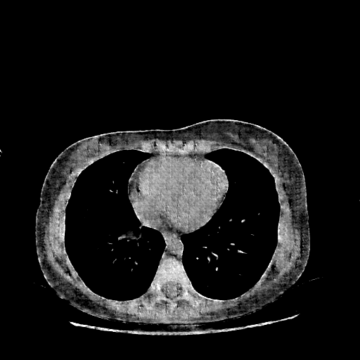 Generated VENOUS CT scan (A→B translation)