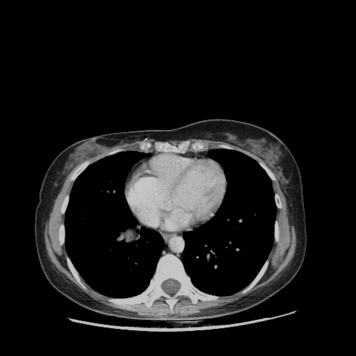 Original VENOUS CT scan