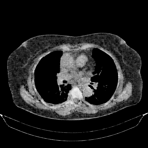 Generated VENOUS CT scan (A→B translation)