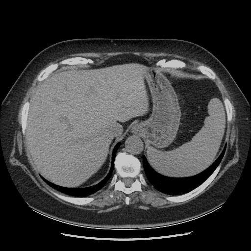 Original NATIVE CT scan (input)