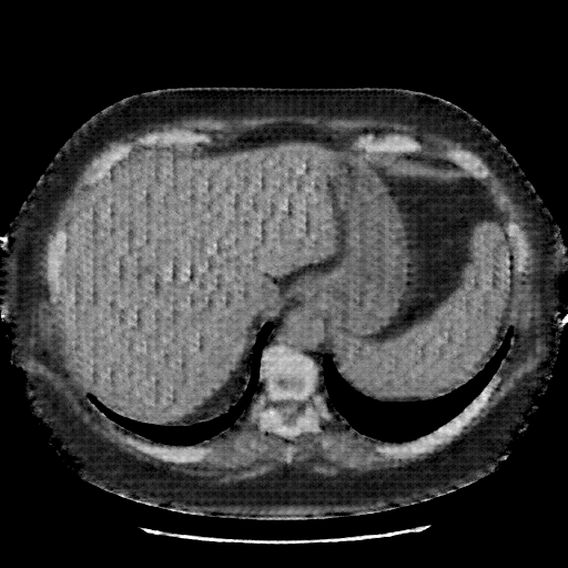 Reconstructed NATIVE CT scan (cycle consistency)