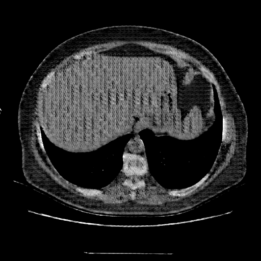Generated VENOUS CT scan (A→B translation)