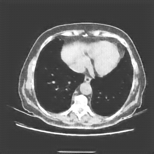 Reconstructed NATIVE CT scan (cycle consistency)