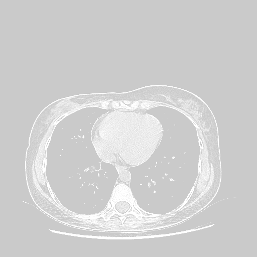 Original NATIVE CT scan (input)