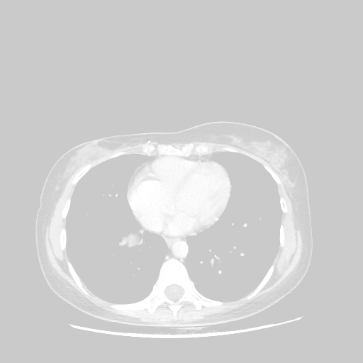 Original VENOUS CT scan