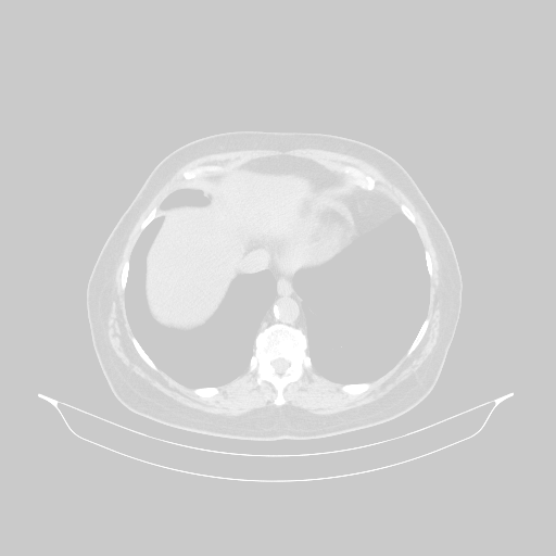 Original NATIVE CT scan (input)