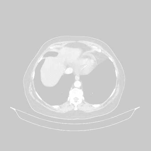 Original VENOUS CT scan