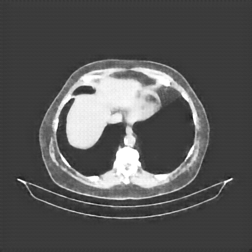 Reconstructed NATIVE CT scan (cycle consistency)