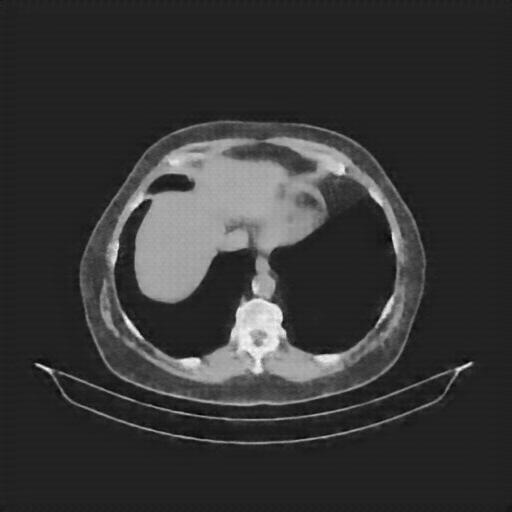 Reconstructed NATIVE CT scan (cycle consistency)