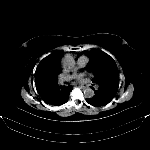 Reconstructed NATIVE CT scan (cycle consistency)