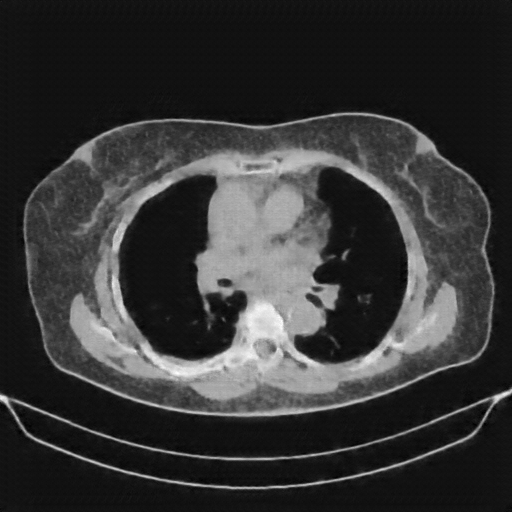 Reconstructed NATIVE CT scan (cycle consistency)