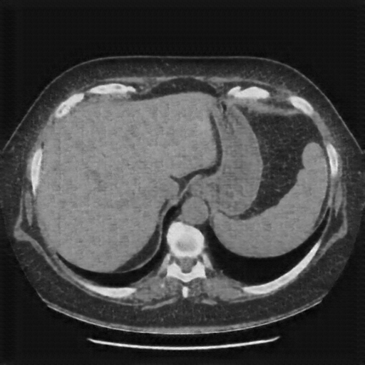 Generated VENOUS CT scan (A→B translation)