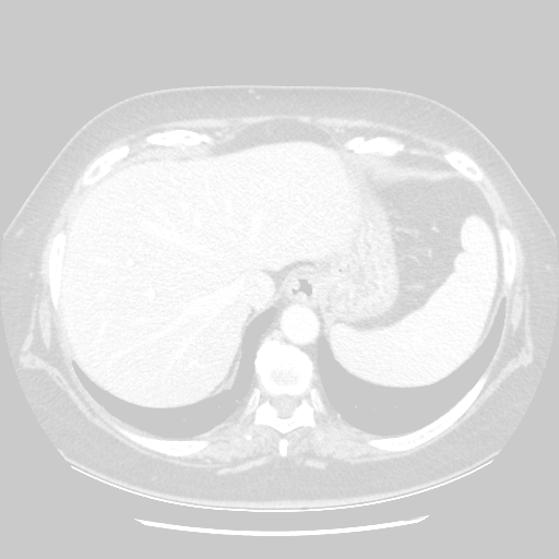 Original VENOUS CT scan