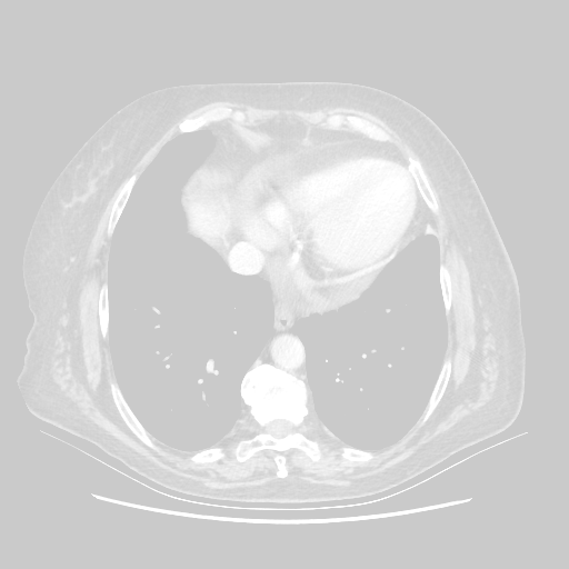 Original VENOUS CT scan