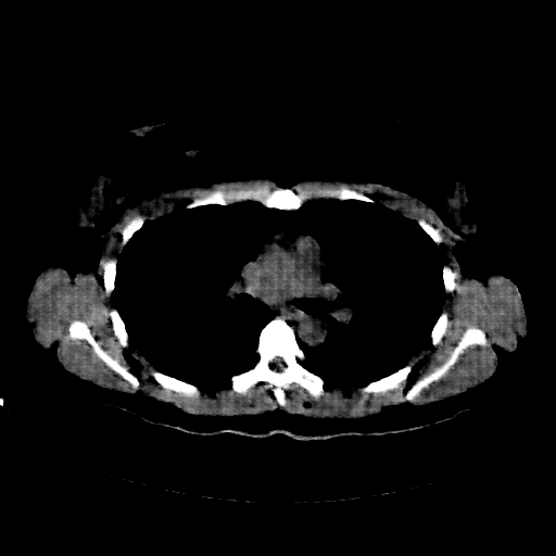 Reconstructed NATIVE CT scan (cycle consistency)