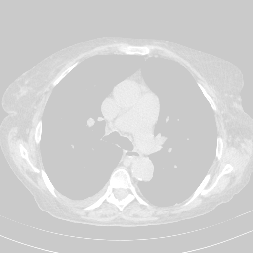 Original NATIVE CT scan (input)