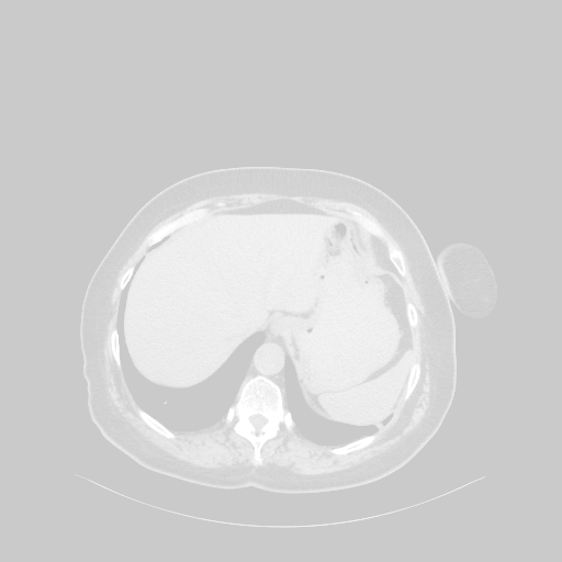 Original NATIVE CT scan (input)