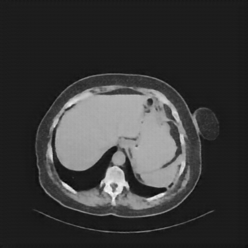 Reconstructed NATIVE CT scan (cycle consistency)