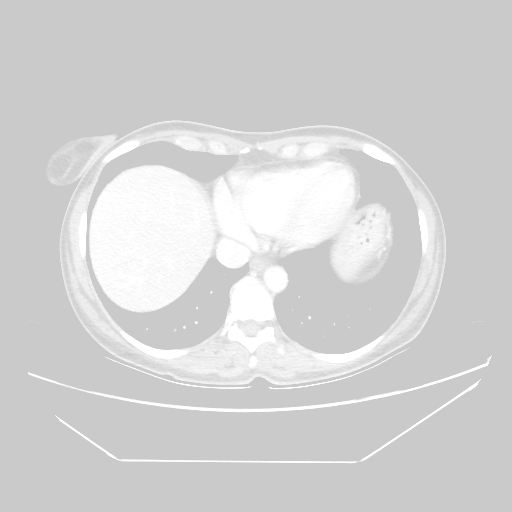 Original VENOUS CT scan