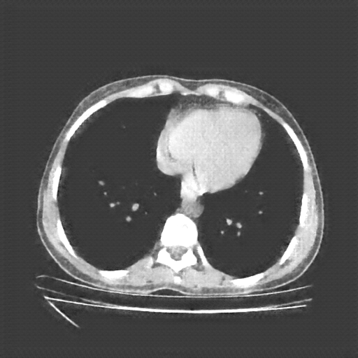 Generated VENOUS CT scan (A→B translation)