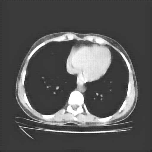 Reconstructed NATIVE CT scan (cycle consistency)