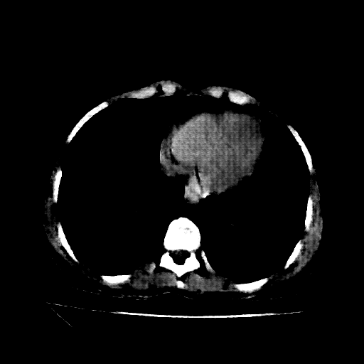 Reconstructed NATIVE CT scan (cycle consistency)