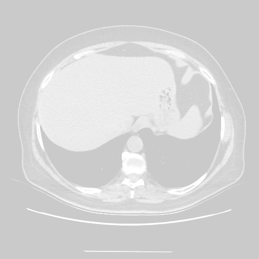 Original NATIVE CT scan (input)