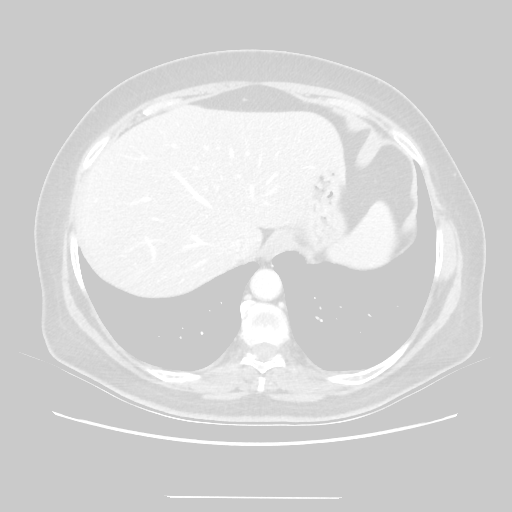 Original VENOUS CT scan