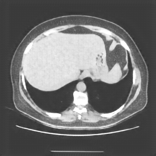 Reconstructed NATIVE CT scan (cycle consistency)
