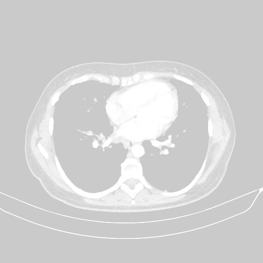 Original VENOUS CT scan