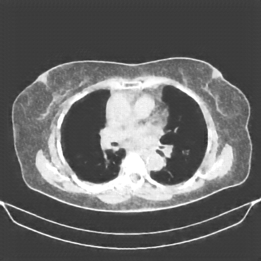 Reconstructed NATIVE CT scan (cycle consistency)