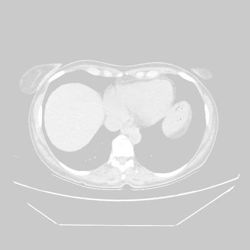 Original NATIVE CT scan (input)