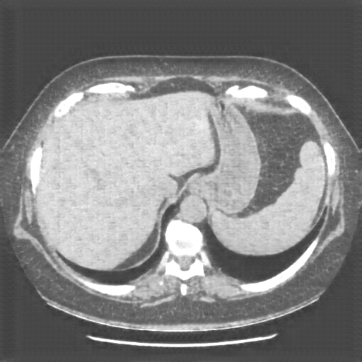 Generated VENOUS CT scan (A→B translation)