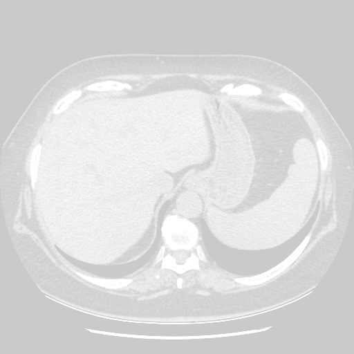 Original NATIVE CT scan (input)