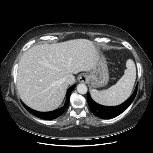 Original VENOUS CT scan