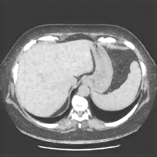 Reconstructed NATIVE CT scan (cycle consistency)