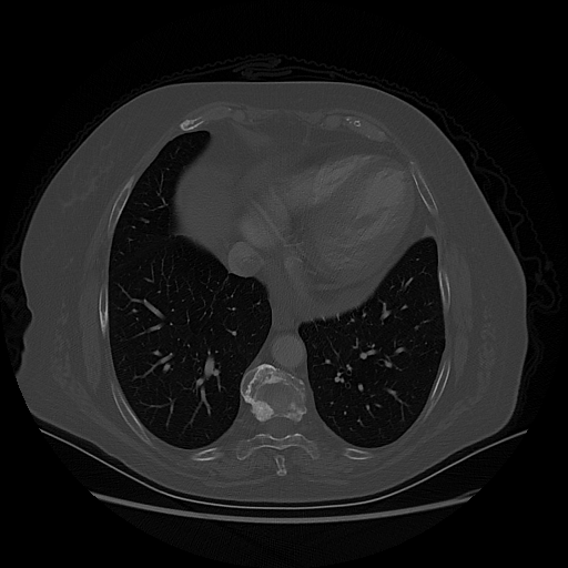 Original NATIVE CT scan (input)