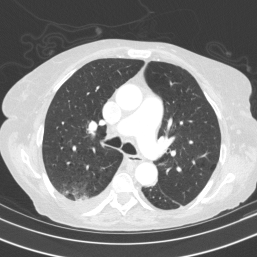 Original VENOUS CT scan