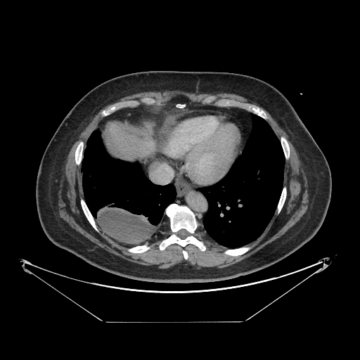 Original VENOUS CT scan