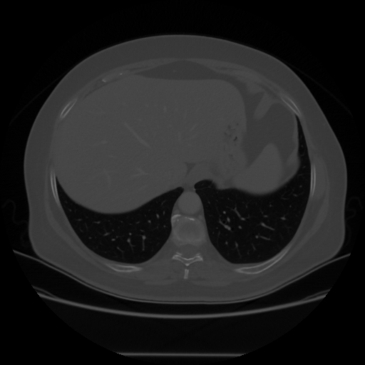 Original VENOUS CT scan