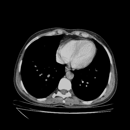 Original VENOUS CT scan