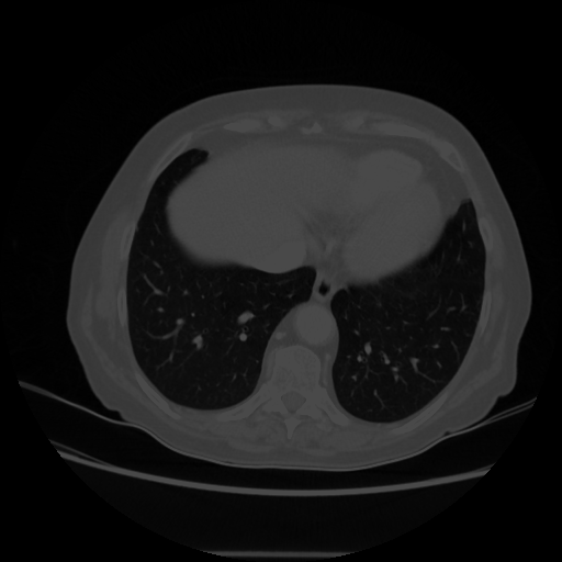 Original VENOUS CT scan