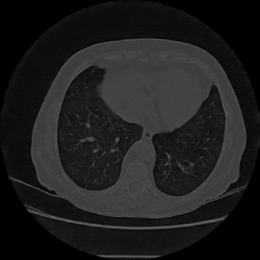 Reconstructed NATIVE CT scan (cycle consistency)