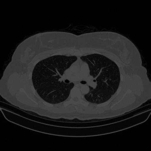 Original VENOUS CT scan