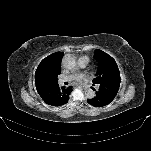 Generated VENOUS CT scan (A→B translation)