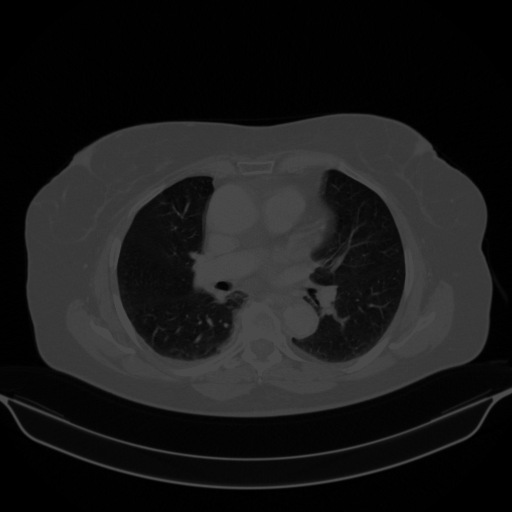 Original VENOUS CT scan